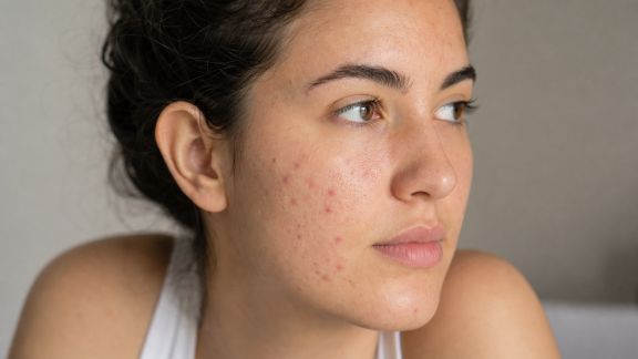 Peau acnéique : stratégies efficaces pour apaiser et prévenir les poussées