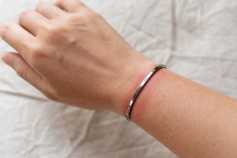 Reconnaître les allergies de contact : quand la peau sensible réagit aux bijoux ou textiles