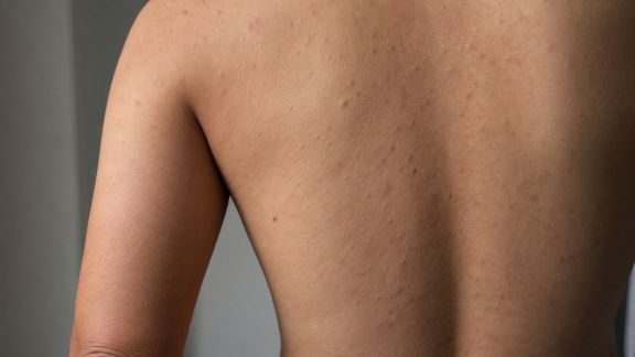 Traiter les imperfections du corps : stratégies pour une peau uniforme