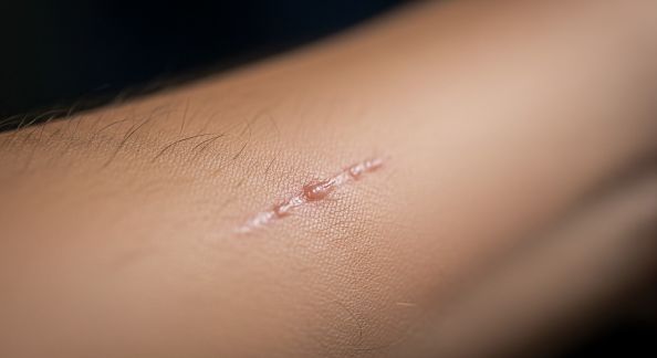 Cicatrices et marques sur le corps : conseils pour les atténuer en douceur